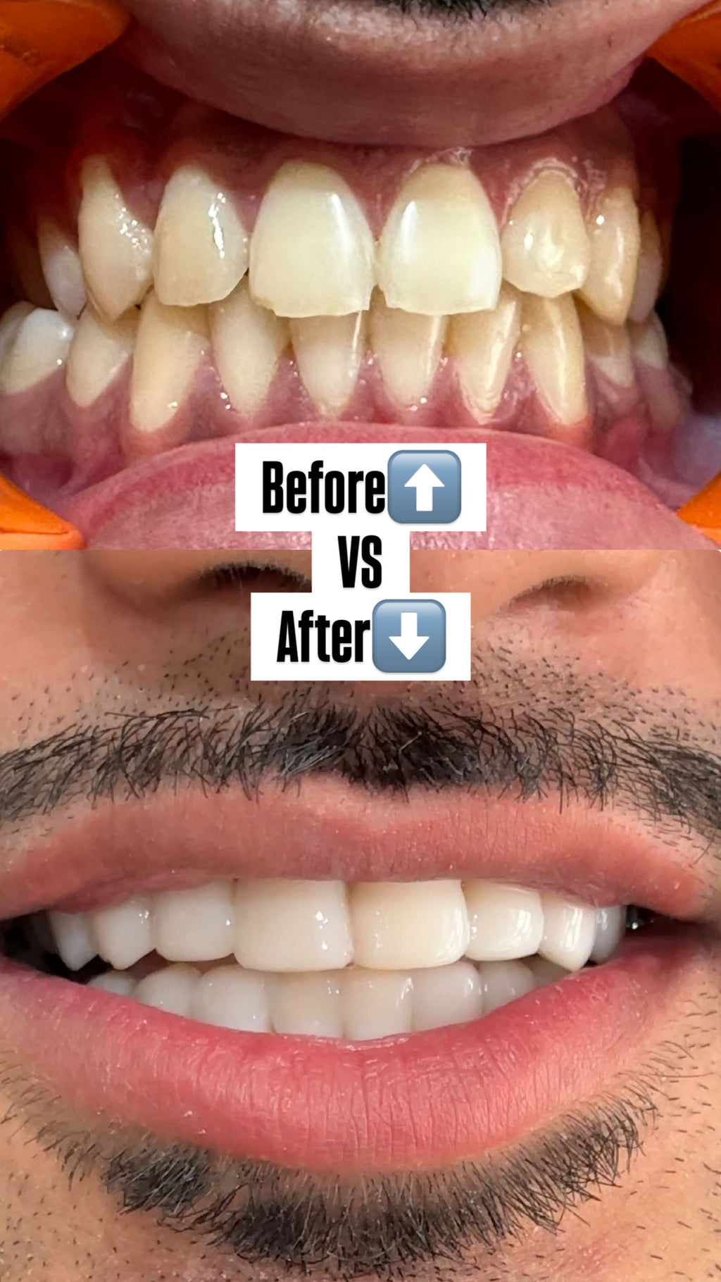 Composite Bonding Option 1
