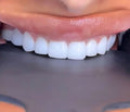 Composite Bonding Option 1